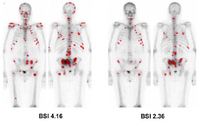 Can we predict outcome after Ra-223? Bone scan index Prognostic biomarker OS: 8.2 months - BSI > 5 vs. 15.