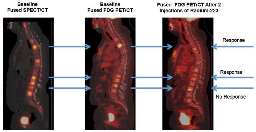 Ra-223 in breast cancer 20 patients had FDG PET/CT identifying 155 hypermetabolic osteoblastic bone lesions at baseline 50 lesions showed metabolic decrease after 2 cycles 32.