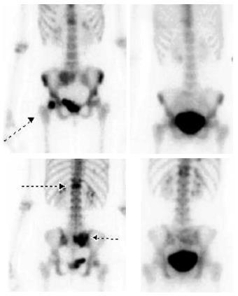 Ra-223 in osteosarcoma Shows great potential since high osteoblastic activity as intrinsic