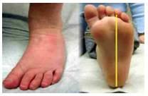 Torticolis or other Foot conditions (clubfoot, metatarsus adductus, calcaneal valgus)! Genetic syndromes Ehler s Danlos, Arthrogryposis, Larsen Syndrome, Spina Bifida!
