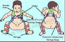 Pavlik Harness Holds hip in Flexion and Abduction (points the femoral head into the socket) - For unstable hips worn full time (except for clothing changes/ bathing) - For stable hips w/ mild DDH