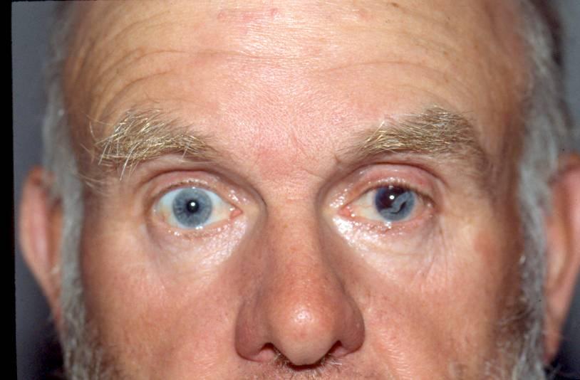 S Iridodialysis S Even 10 mm pupils with bunched up iris in angle can be