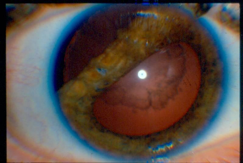 Iridodialysis Cataract Zonular