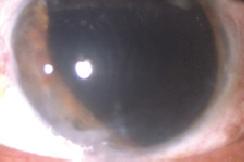 3/20/16 Human Optics Implants Summary S Pupillary