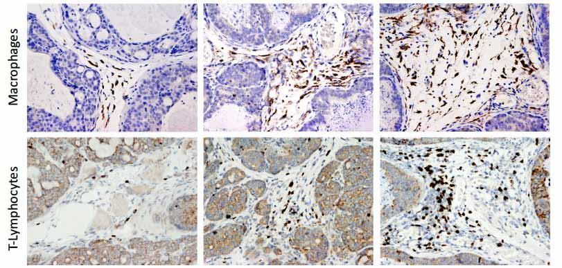 Dramatic Increases are Seen in Stromal Inflammatory Cell