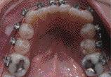 brackets on maxillary laterals and mandibular right lateral.
