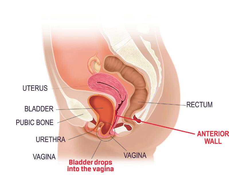 Bladder: If the pelvic floor is weak, the bladder, which rests on this area of the vagina, can drop out of position.