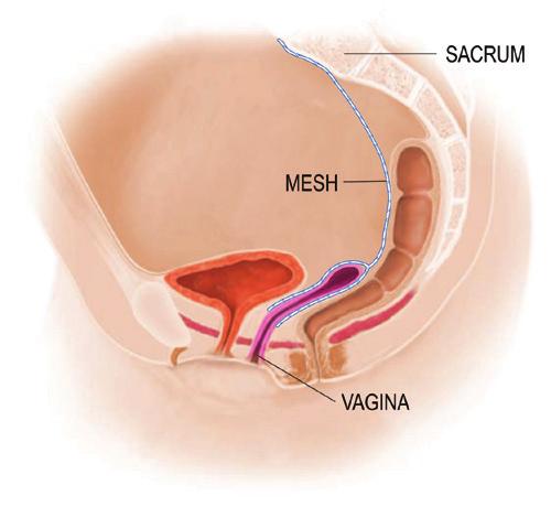 Transvaginal synthetic mesh repair: Using incisions inside the vagina, the surgeon repositions the prolapsed organs and secures them to surrounding tissues and ligaments using mesh