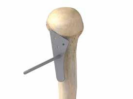 Step 5 Humeral Head Preparation and Resection Assess the humeral head and remove any unwanted osteophytes to return the proximal humerus to near native anatomy.