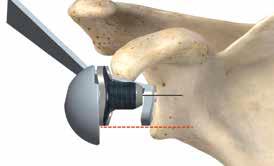 9-3 Note: The Glenoid Wire Guide without the lip references the inferior edge of the Baseplate.