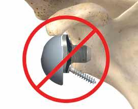9-6 Placing the guide too low and diverging the inferior screw could allow for inadequate inferior screw fixation 9-6 9-7