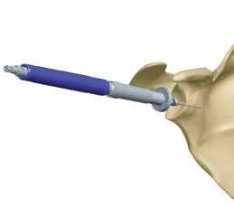 If increased retroversion is noted on preoperative imaging studies, then orient the Glenoid Wire Guide to correct this