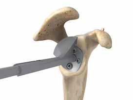 11-2 If remaining bone around the periphery of the Baseplate is preventing the Glenosphere Trial from seating, the associated Peripheral Reamer, Concentric or Eccentric can be used manually to clear