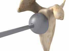 Note: When possible the Reverse Humeral Body should be positioned within the metaphyseal bone to maximize implant construct support.