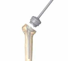 Humeral Poly Liner Insertion 13-3 Place the definitive Standard or Retentive Poly Liner in the implanted Reverse Body taking care to orient the pilot tip on the underside of the Poly Liner with the