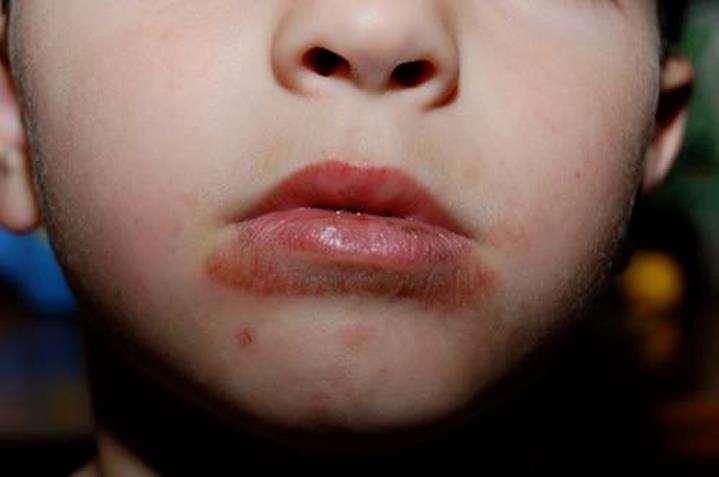 LIP LICKING HABIT Habitual licking of the lips and the surrounding skin causes a condition called lip licker s dermatitis.