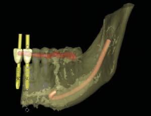 Implant Planning and Surgical Treatment After approximately 6 months of healing, a CT scan was taken to evaluate the width and height of the augmented ridge available to perform a flapless implant
