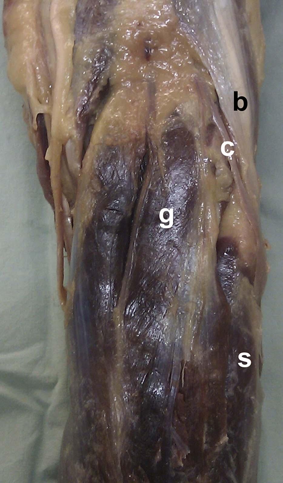 Heidari et al J Orthop Trauma Volume 27, Number 4, April 2013 FIGURE 1. Posterior aspect of the right knee with skin and superficial fascia removed.