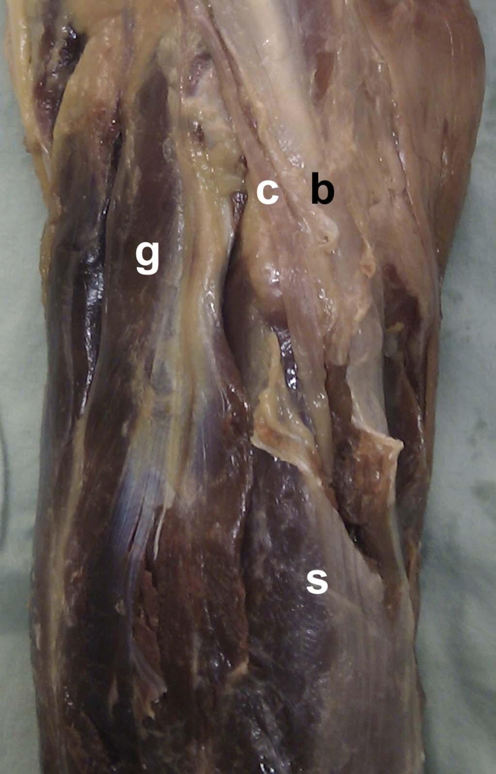 Once the anterior tibial artery was identified as it coursed through the interosseous membrane, a posterior arthrotomy was performed locating the joint line (Fig. 6).