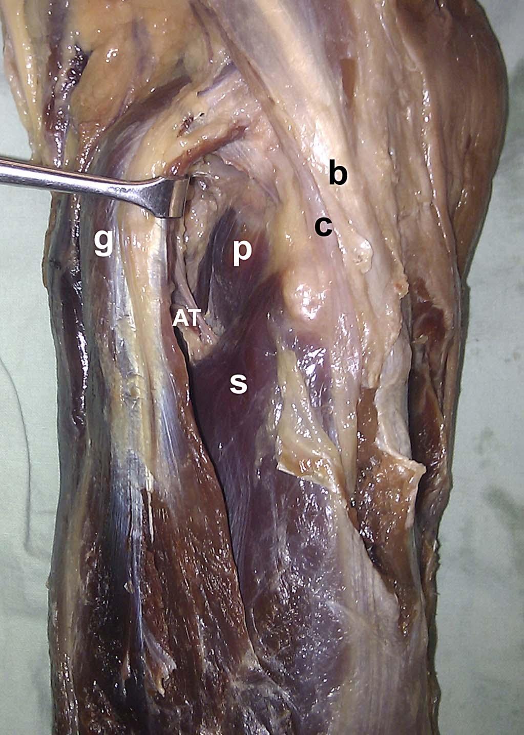 J Orthop Trauma Volume 27, Number 4, April 2013 Risk of Injury to the Anterior Tibial Artery FIGURE 3.