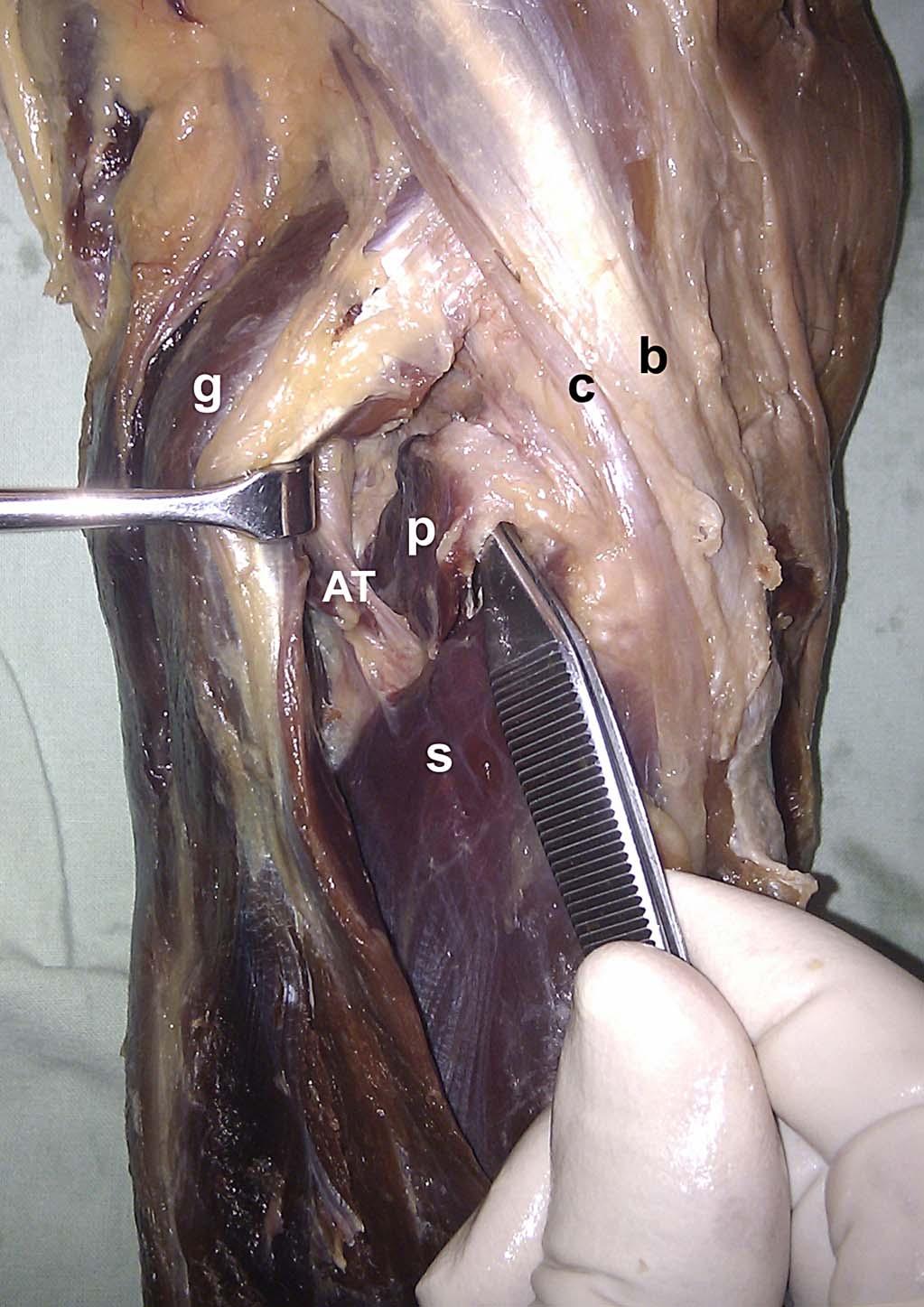 This brought the tendon of popliteus muscle (p), the belly of soleus muscle, and anterior tibial (AT) artery into view. Biceps femoris muscle (b) and common peroneal nerve (c). a computed tomography.