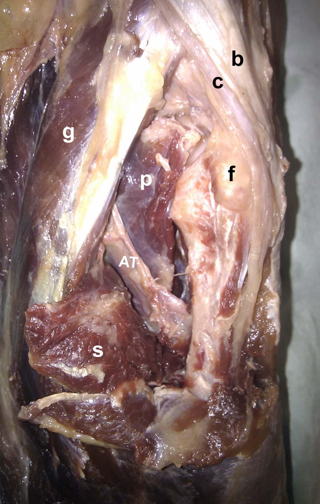 Heidari et al J Orthop Trauma Volume 27, Number 4, April 2013 FIGURE 5. The soleus muscle (s) is released from its origin on the posterior aspect of the fibula (f) and retracted medially.