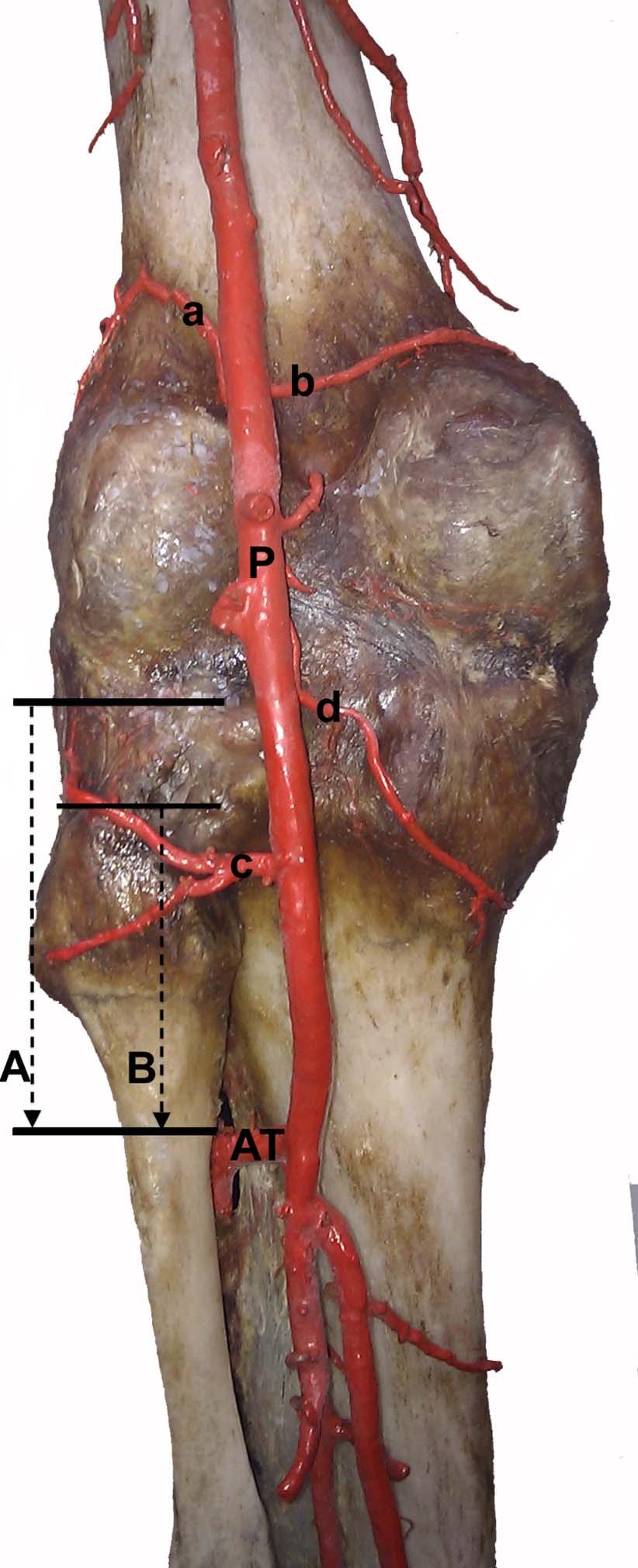 J Orthop Trauma Volume 27, Number 4, April 2013 Risk of Injury to the Anterior Tibial Artery FIGURE 8.