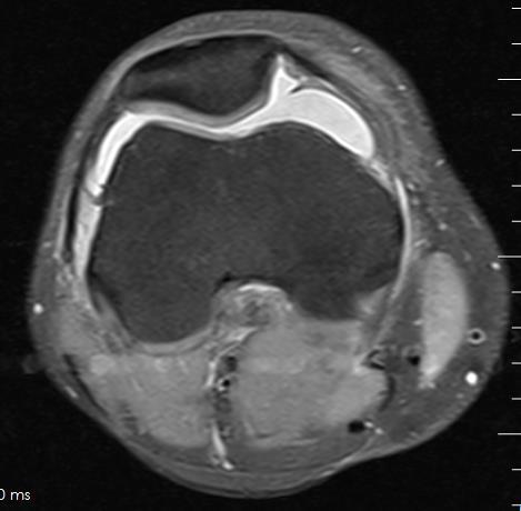 Knee Imaging: MRI Utilize proton density ( PD ) and fat-saturated proton density ( PD fat-sat