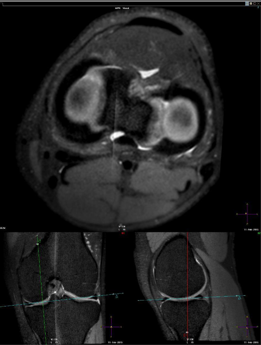 Knee Imaging: MRI Our protocol: Coronal PD and PDFS Sagittal PD
