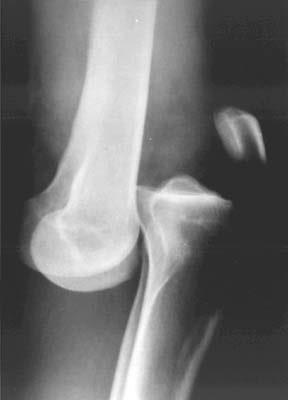 Anterior Dislocation 31% dislocations, hyperextension mechanism ACL and PCL usually torn MCL and LCL