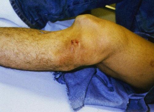 Lateral knee dislocation Rare No vascular injury