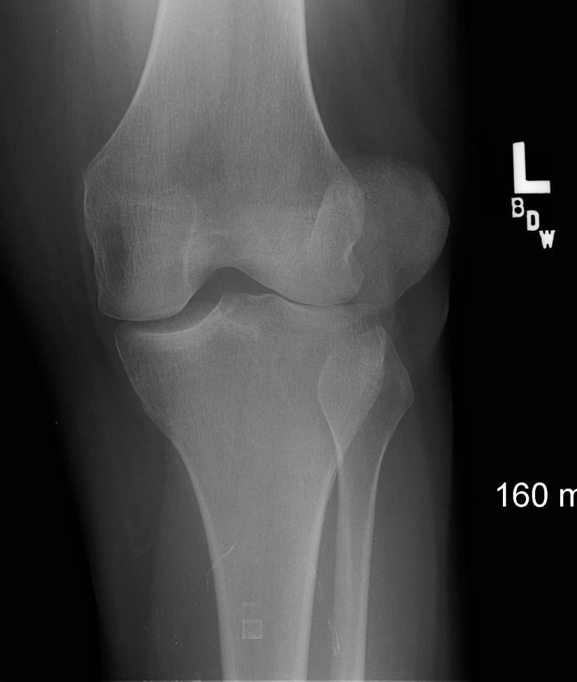 Patellar Dislocation Usually transient Common knee dislocation
