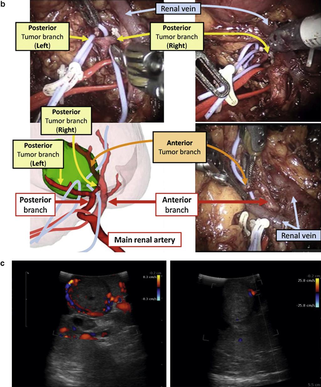 [(_)TD$FIG][(_)TD$FIG] EUROPEAN UROLOGY 61 (2012) 211 217 213 Fig. 2. (Continued ). the 3D arteriogram with 3D surface-rendered tumor and kidney models.