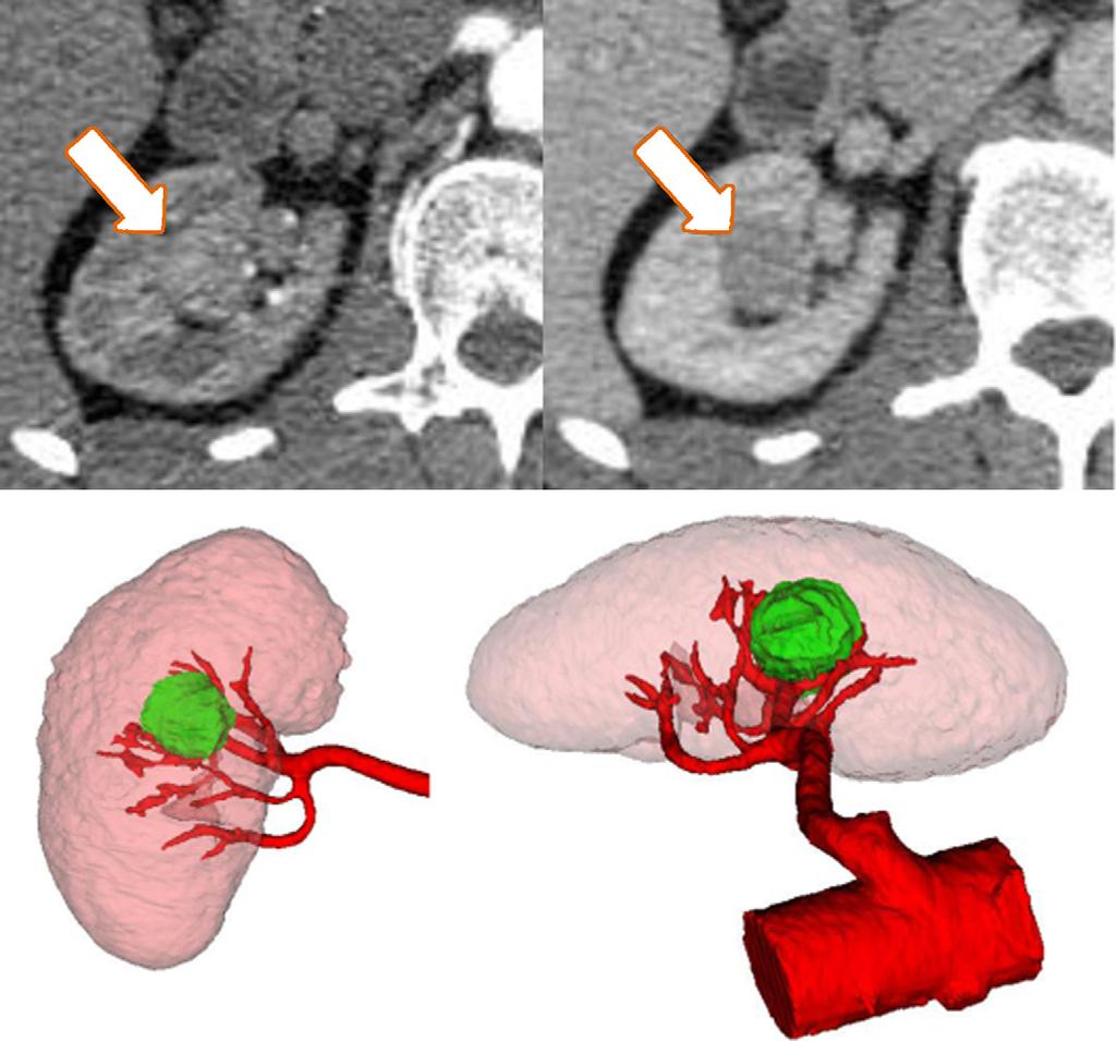 214 [(Fig._3)TD$FIG] EUROPEAN UROLOGY 61 (2012) 211 217 Fig. 3 Case 2: A 58-yr-old man with right 2.4 cm completely intrarenal central hilar mass.