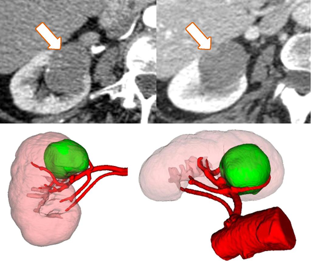 [(Fig._4)TD$FIG] EUROPEAN UROLOGY 61 (2012) 211 217 215 Fig. 4 Case 3: A 69-yr-old woman with a right 4-cm central, upper-midpole medial hilar mass abutting collecting system and hilar vessels.