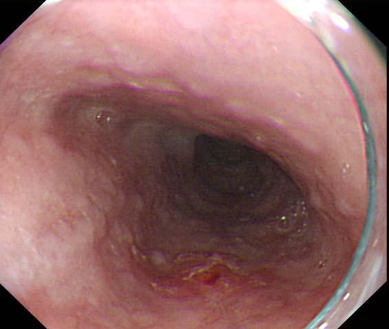 How to recognize Superficial Esophageal