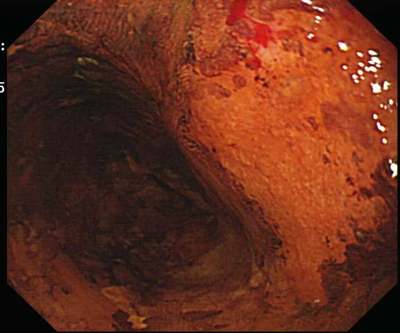 mucosa dark brown stain Dysplasia / ca esophagus