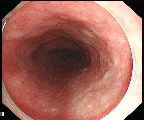 Superficial esophageal