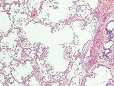 Case A 62-year-old man with invasive adenocarcinoma, lepidic