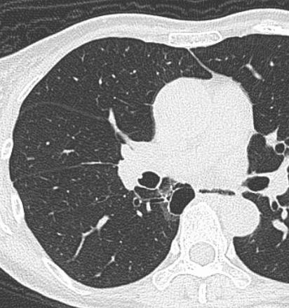 The evaluation of pre-existing cavity by emphysema,