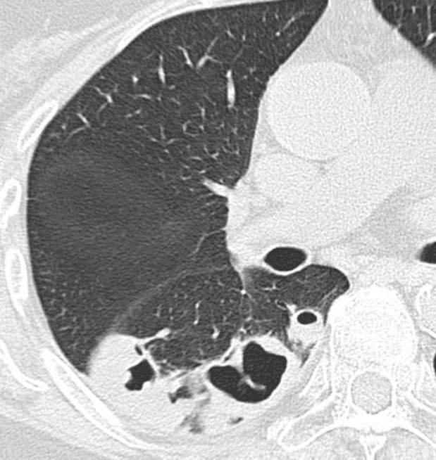 Cavitation Greater extent of lung involvement and greater