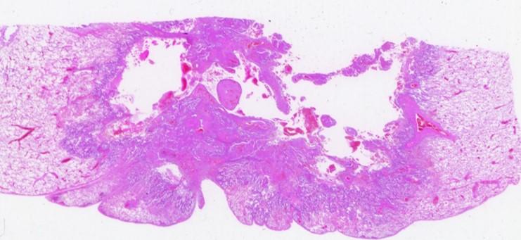 Case A 60-year-old man with invasive adenocarcinoma,