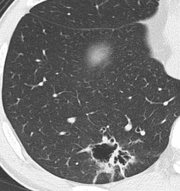 Emphysema is not observed in the adjacent lung