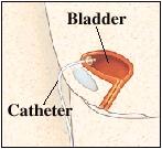 Continuous Drainage: Suprapubic A surgical procedure places a tube directly in the bladder A balloon is inflated to