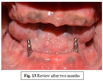 References [1]. Schimmel M, Srinivasan m, Hermann FR, Muller F.Loading protocols for implant- supported overdentures in the edentulous jaw: A systematic review and meta-analysis. Int.
