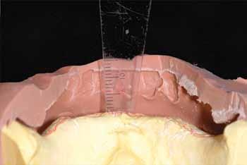 May 2011 287 A B 1 A, Measurement from crest of residual ridge to incisal edges of matrix incorrectly dictates availability of 12 mm of prosthetic space.