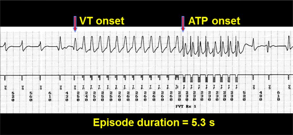 Anti Tachycardia Pacing (ATP) Overdrive pacing with shorter cycle length of tachycardia could terminate the tachycardia The Failure of ATP termination may