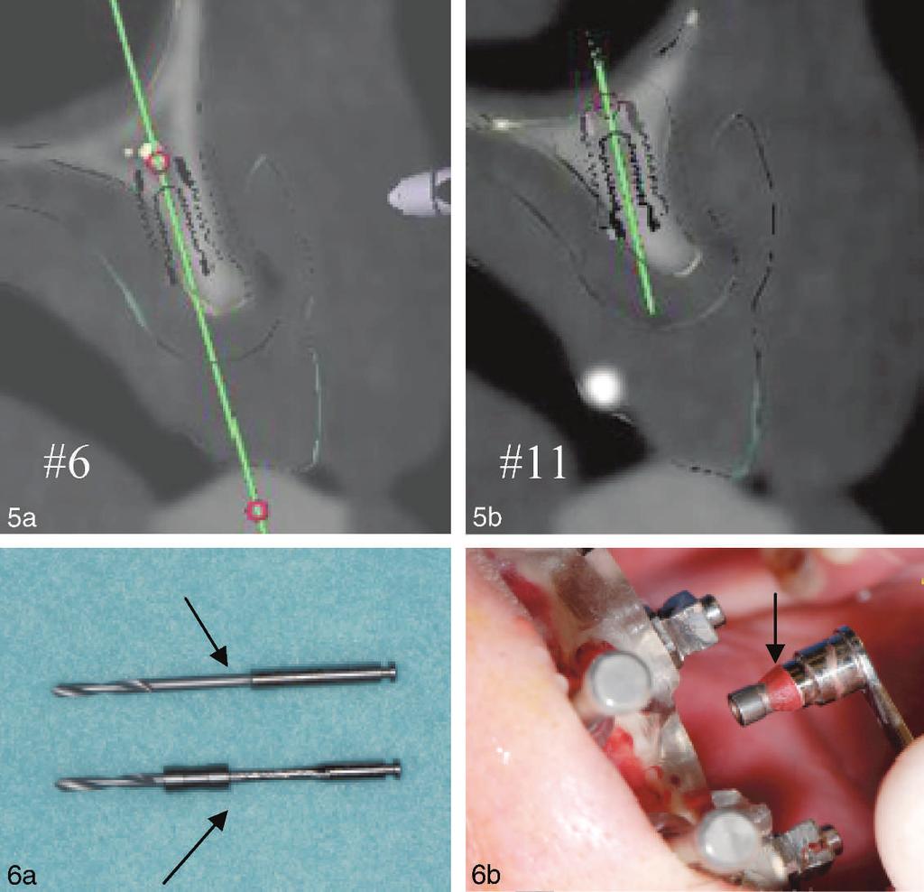 Guided Flapless Immediate Loading in the High Narrow Ridge FIGURES 5 AND 6. FIGURE 5. The implants placed in the compromised sites. FIGURE 6. (a) Modification of the 1.