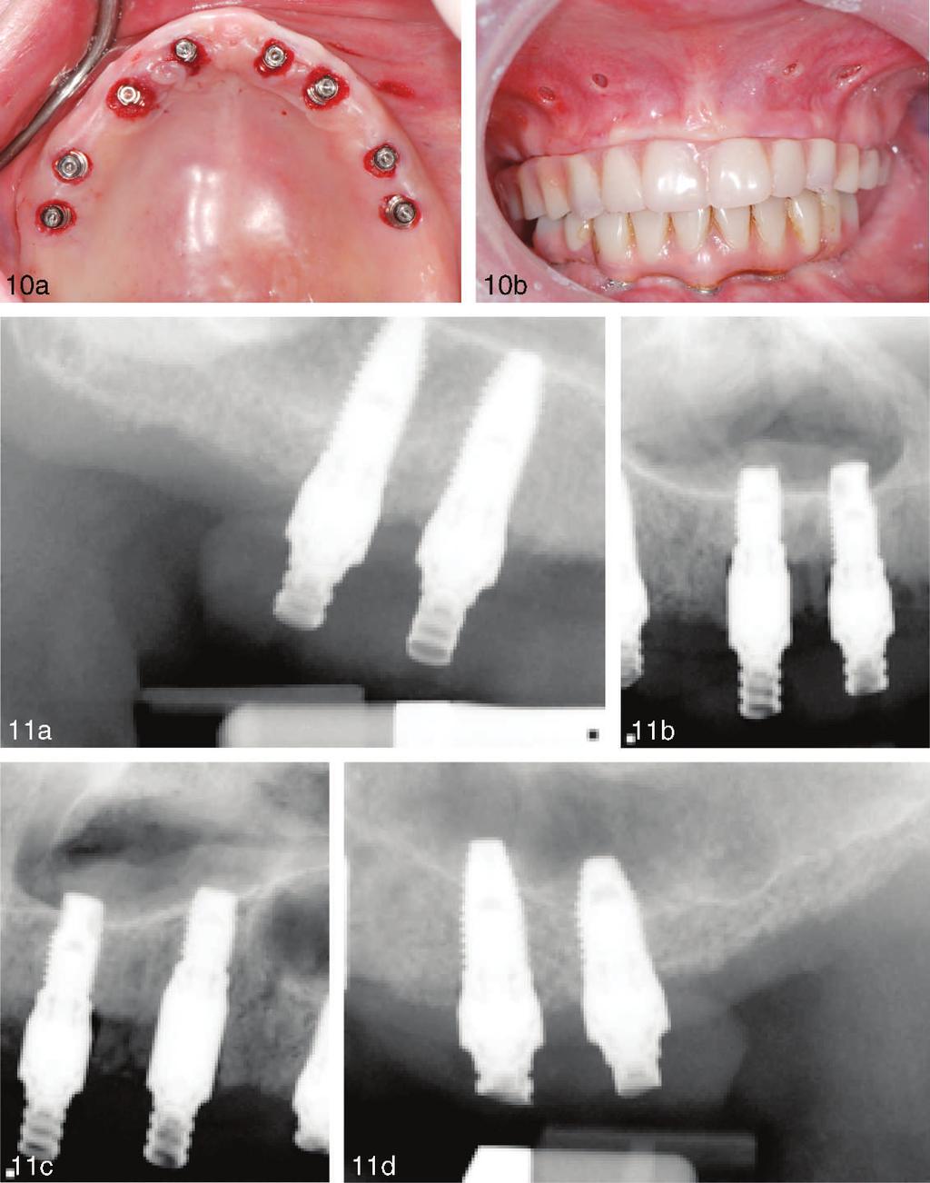 Guided Flapless Immediate Loading in the High Narrow Ridge FIGURES 10 AND 11. FIGURE 10. (a) Immediate placement of implants with multiunit abutments to within 1 mm of the soft-tissue crest.