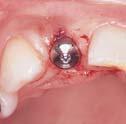 27 Flapless Implant Surgery in the Esthetic Region: Advantages and Precautions Tae-Ju Oh, DDS, MS 1 /Jeffrey Shotwell, DDS, MS 2 Edward Billy, DMD 3 /Ho-Young Byun, DDS, PhD 4 Hom-Lay Wang, DDS, MSD